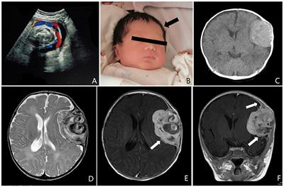 Case Report: Congenital Intracranial Kaposiform Hemangioendothelioma Treated With Surgical Resection